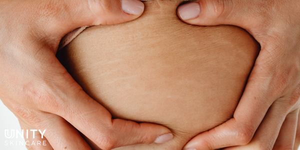 Does Collagen Help With Stretch Marks? Here's What You Need to Know